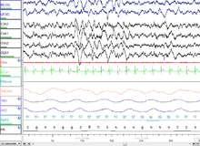 30 seconds of N3 - deep sleep. Sleep Stage N3.png