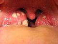 Gola con tonsillite batterica