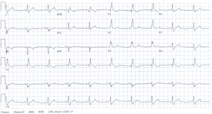 Бифасцикулярная блокада ECG.png