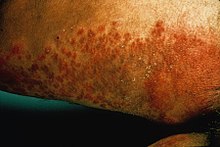 Skin candidiasis Derm-57.jpg