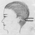 Demonstration of the placement of a tuning fork during the Rinne test