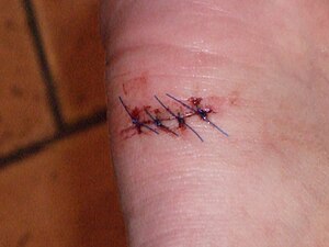 English: six sutures stitches in achilles heel...
