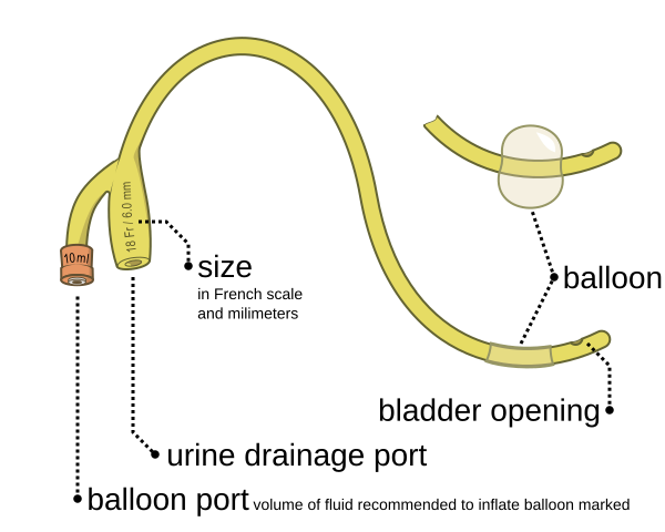 600px-Foley_catheter_inflated_and_deflat