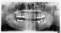 Панорамная рентгенограмма показывает нижние зубы мудрости с горизонтальным ретинированием.