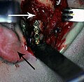 Rigid internal fixation of right condyle fracture with mini-plate on the neck of the condyle. Black arrow marks right earlobe, white arrow marks head of the condyle