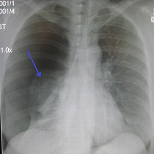 Ipinapakita ng X-ray ng dibdib ang pneumothorax sa kanan (kaliwa sa larawan), na kung saan itinuturo ng palatandaang pangbaga ang libreng hangin sa loob ng dibdib