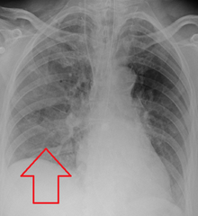 Aspiration pneumonia in a ventilated person with a central line and nasogastric tube AspirationPneumonia.png