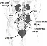 Kidney location after transplantation.