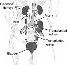 kidney transplant pictures