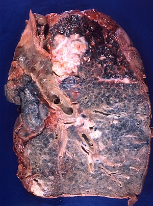 Плоскоклетъчен карцином на белия дроб, развиващ се в бронхите