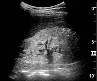 Nephrotic syndrome. Hyperechoic kidney without demarcation of cortex and medulla.[55]