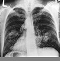 Radiografia del torace che mostra opacità ilari e mediastiniche bilaterali compatibili con infiltrazione linfonodale metastatica da tumore primitivo del polmone.