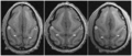 Transverse sections of brains of vervet monkey. It showing difference of the relative position of the left and right ascending ramus of the cingulate sulcus.