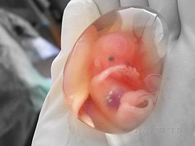 амнионера 8-кӀиран эмбрион (пхораллин 10-гӀа кӀира), схьадаьккхина беран цӀен лаган карцинома йолчу зудчун, беран цӀа дӀадоккхуш операци еш