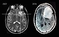 MRI scans of an astrocytoma patient, showing tumor progression over the course of seven years.