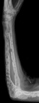 Röntgenbild med multipla osteolysområden på en underarm. Även en patologisk fraktur distalt på armbågsbenet (ulna).