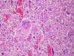 Giant cell carcinoma - Case 284 (13107156794).jpg