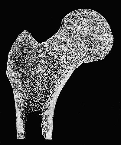 Twisted Femur