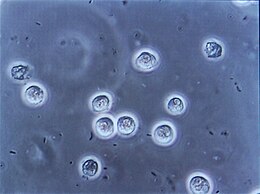 Description de l'image Bacteriuria pyuria 4.jpg.