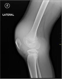 Радиографски налаз крварења у зглобу колена - са стране