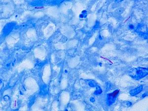 Potential Vaccine Readies Immune System to Kill Tuberculosis in Mice