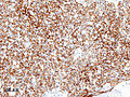 A B1 típusú thymoma szövettani képe. Az elülső mediastinalis tömeget műtéti úton kivágták. Cytokeratin CAM5.2 immunfesték.