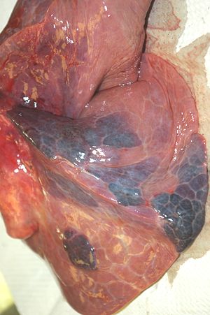 AC08-7 pulmonary infarcts.JPG