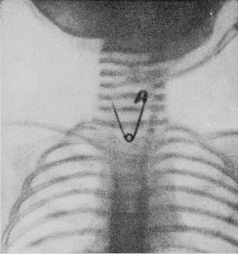 image of safety pin in a child's esophagus