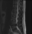 A rather severe herniation of the L4-L5 disc.