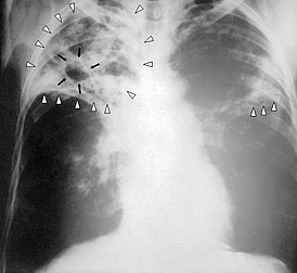 Рэнтгенаграма органаў грудной клеткі хворага на туберкулёз лёгкіх