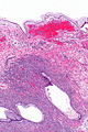 Ovariální mucinózní cystadenom - alt - nízký mag.jpg