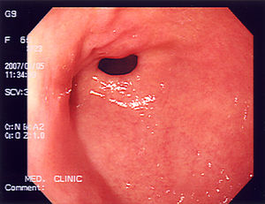 An endoscopy of a normal stomach of a healthy ...