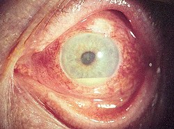 غمير قيحي في التهاب عنبية داخلي, يظهر على شكل قيح مصفر في الجزء الداخلي من العين.