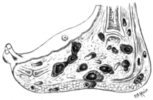 Madura foot section Tropical Diseases - Fig 206.png