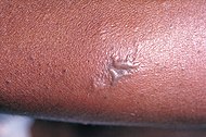 Gonococcal lesion on the skin PHIL 2038 lores.jpg