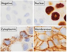 Main staining patterns on chromogenic immunohistochemistry. Main staining patterns on immunohistochemistry.jpg