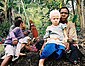 Okulokutaner Albinismus Typ 1