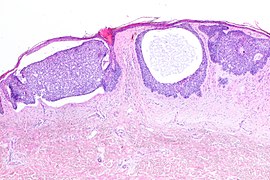 nodulozystisches Basalzellkarzinom