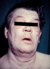 Man with myxedema or severe hypothyroidism showing an expressionless face, puffiness around the eyes and pallor