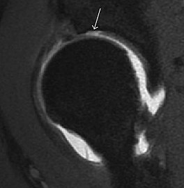 Sagittal T1 weighted image showing chondral lesion.[1]