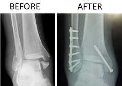 X-ray of trimalleolar fracture repair before and after ORIF surgery