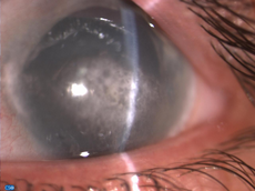 Band-keratopathy-maldekstra-eye.png