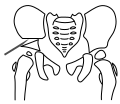 Salter-Osteotomie, Schritt 2