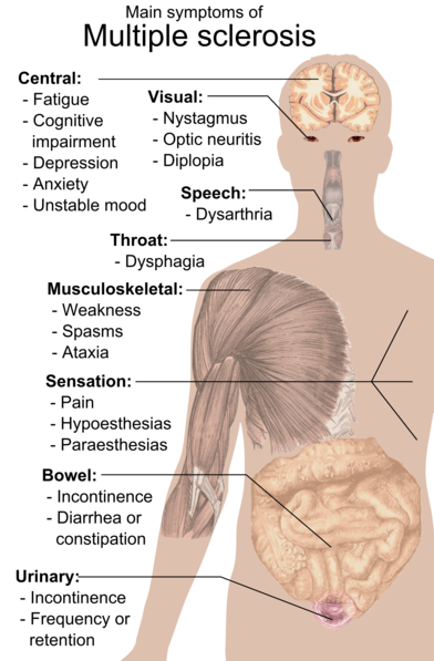 File:Symptoms of multiple sclerosis.png