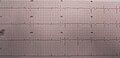 EKG/ECG of the same person when pain-free, note the biphasic T waves in leads V2 and V3