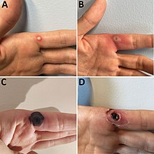 Progression of monkeypox after needlestick injury from a pustule at work[37]