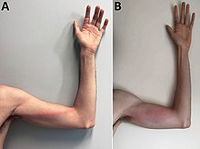 Tender, indurated, erythematous, and well-delimited linear streak from the left finger to the armpit, on the seventh day of illness. B) Aggravated lymphangitis on the ninth day of illness.