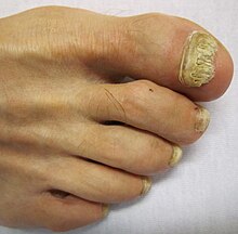 Toe-Nail Fungus