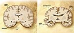 Comparação entre um cérebro idoso normal (esquerda) e o cérebro de uma pessoa com Alzheimer (direita), estando assinaladas as características diferenciadoras