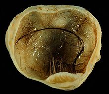 Mature cystic teratoma of ovary Mature cystic teratoma of ovary.jpg